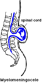 Myelomeningocele drawing